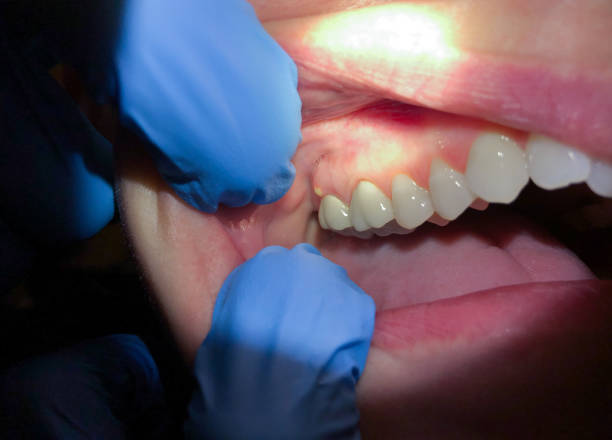 Tooth Infection Emergency Dentist in CT